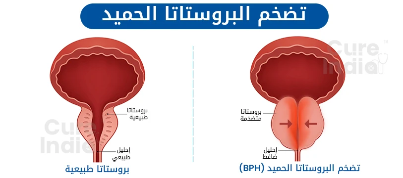 ما هو urolift لعلاج تضخم البروستاتا الحميد في الهند؟